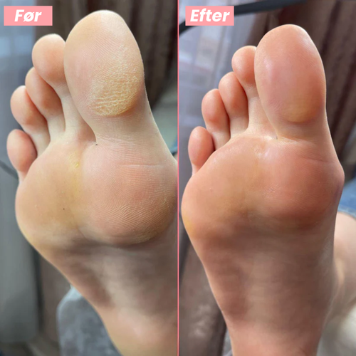 FootGlow™ - Professionel fodpleje derhjemme.