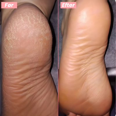 FootGlow™ - Professionel fodpleje derhjemme.