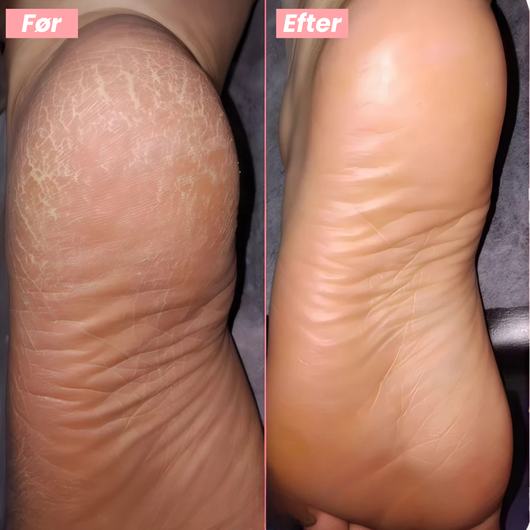 FootGlow™ - Professionel fodpleje derhjemme.