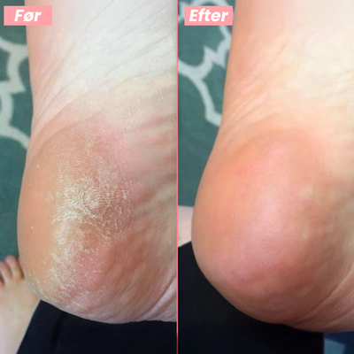 FootGlow™ - Professionel fodpleje derhjemme.