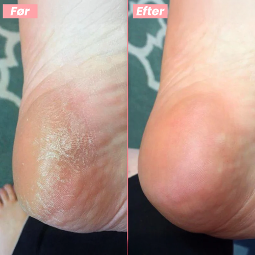 FootGlow™ - Professionel fodpleje derhjemme.